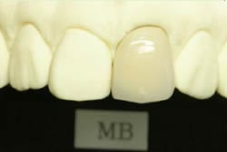 メタルボンドクラウン MB