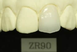 歯ピアクラウンオールセラミック AC メタルフリー(CAD/CAMシステム)