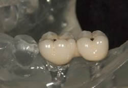 Cement retain (セメント固定タイプ)