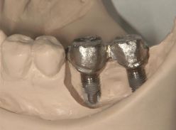 補綴修復のバリエーション(臨床例の紹介)